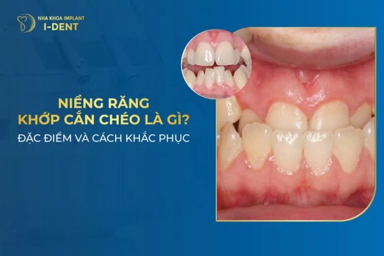 niềng răng khớp cắn chéo