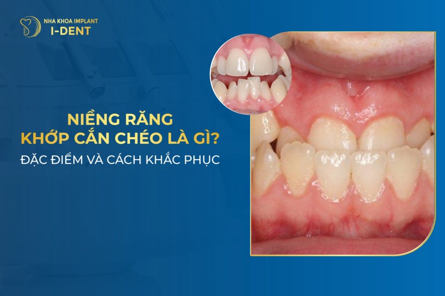Khớp cắn chéo là gì? Cách khắc phục cắn chéo hiệu quả