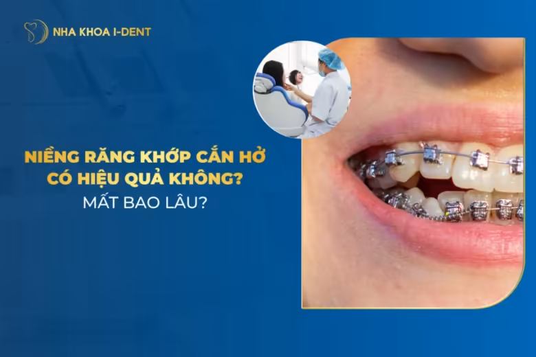 niềng răng khớp cắn hở