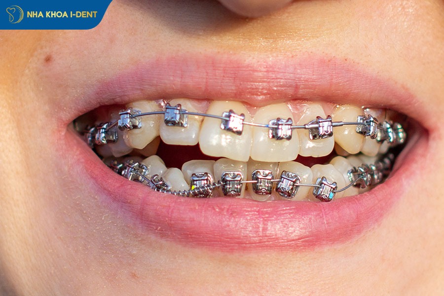 niềng răng khớp cắn hở mất bao lâu