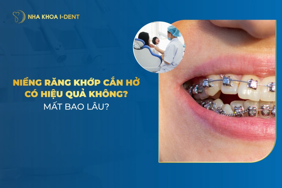 Niềng răng cắn hở có hiệu quả không? Phương pháp thực hiện