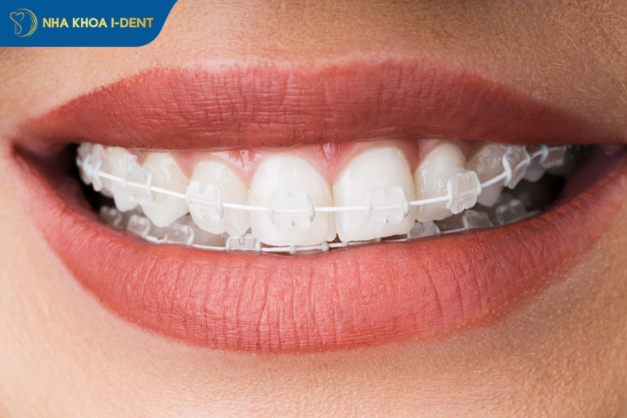 chi phí niềng răng khớp cắn ngược - Nha khoa I-Dent