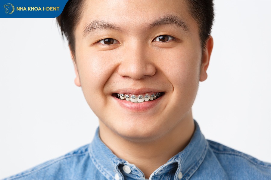 Niềng răng khớp cắn sâu bằng mắc cài kim loại