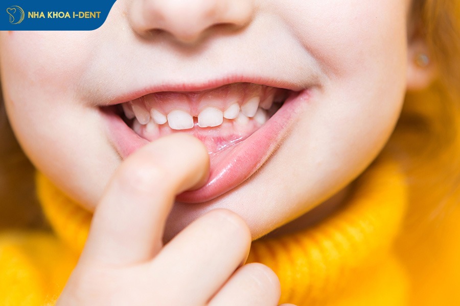 niềng răng khớp cắn sâu bao lâu