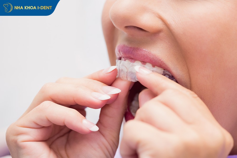 Niềng răng khớp cắn sâu phương pháp invisalign