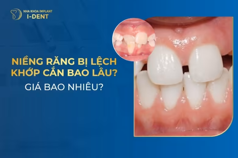 Niềng Răng Lệch Khớp Cắn Bao Lâu? Bao Nhiêu Tiền?