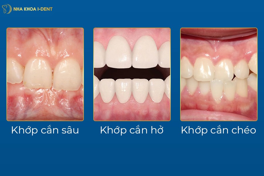 niềng răng lệch khớp cắn bao lâu