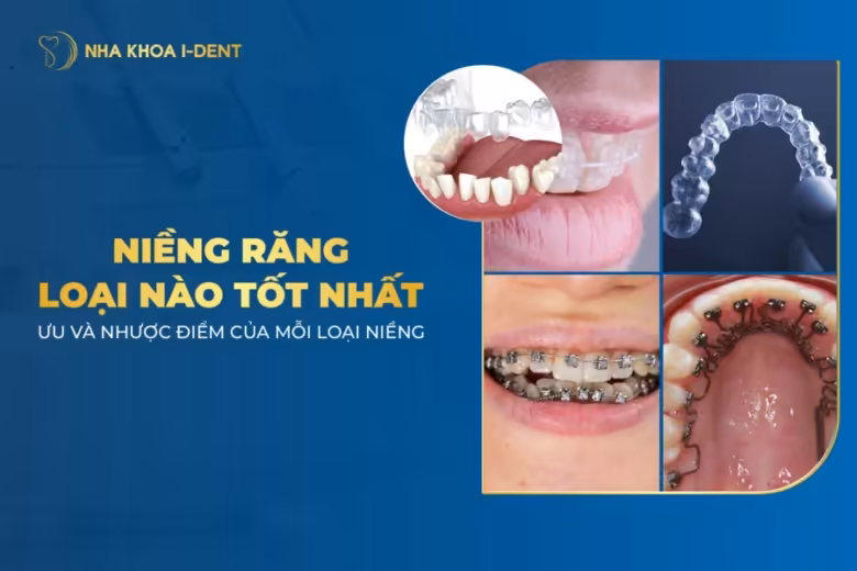 niềng răng loại nào tốt nhất