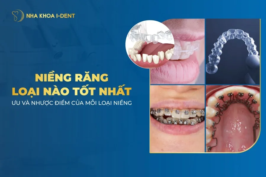 niềng răng loại nào tốt nhất
