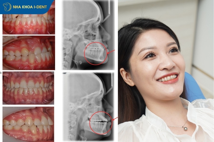 niềng răng móm có hiệu quả không