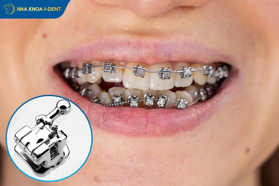 niềng răng nào tốt nhất