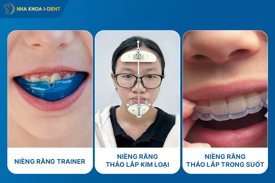 niềng răng tháo lắp trẻ em