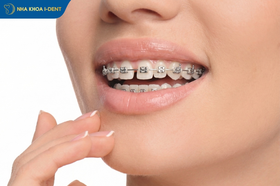 răng thưa niềng trong bao lâu