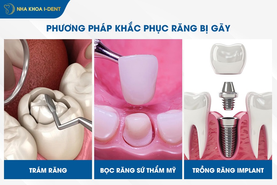 Có 3 phương pháp khắc phục răng bị gãy