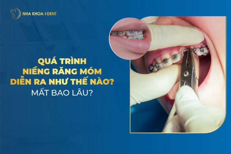 quá trình niềng răng móm