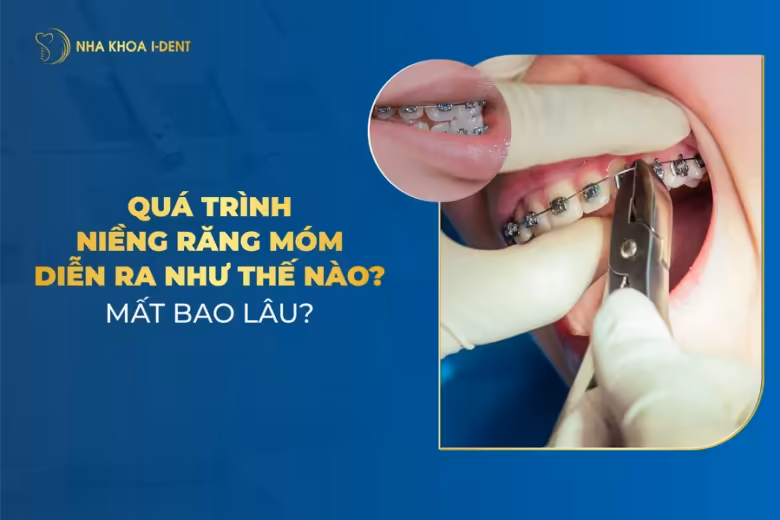 quá trình niềng răng móm