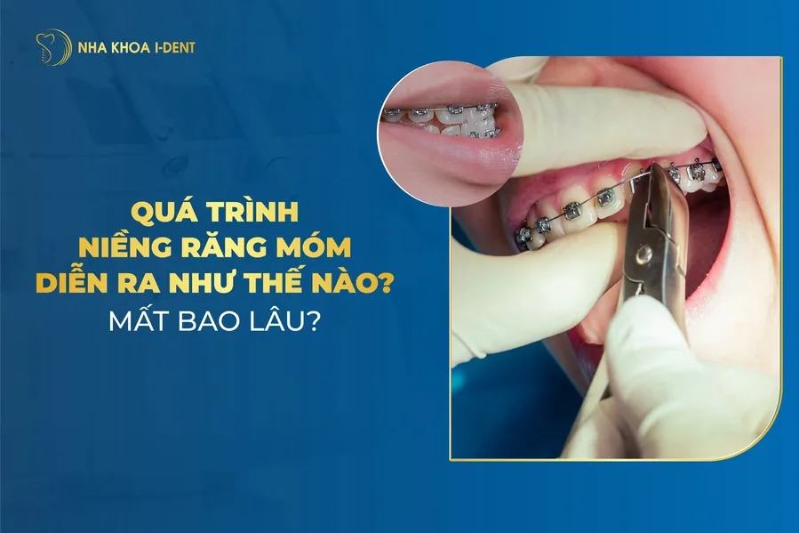 quá trình niềng răng móm