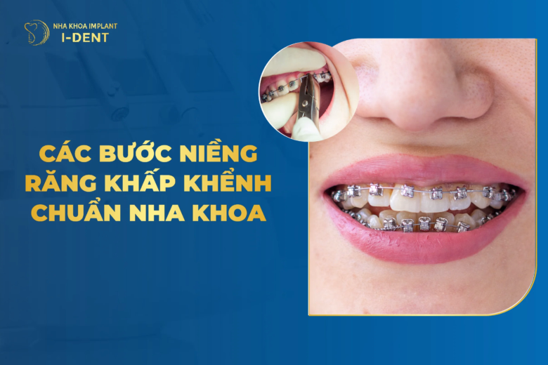 quy trình niềng răng khấp khểnh