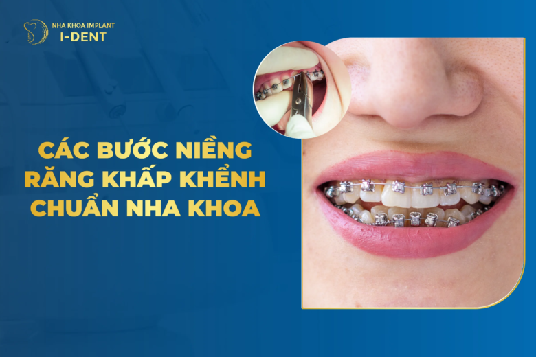 Các Bước Niềng Răng Khấp Khểnh Chuẩn Nha Khoa