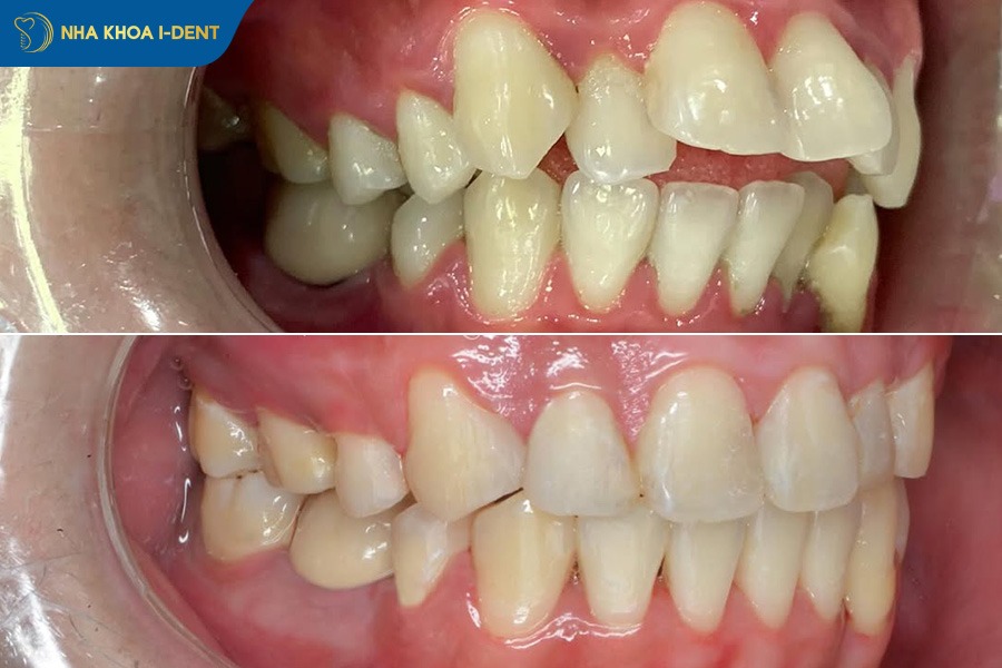 quy trình niềng răng khớp cắn hở