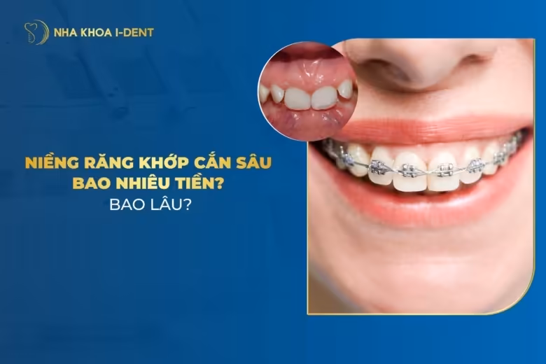 Niềng Răng Khớp Cắn Sâu Bao Nhiêu Tiền? Quy Trình?