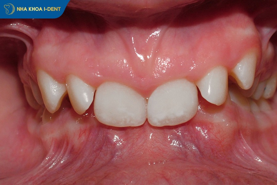 quy trình niềng răng khớp cắn sâu