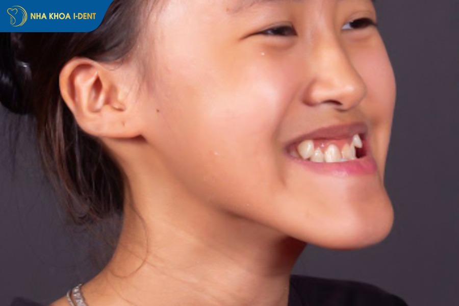 quy trình niềng răng móm