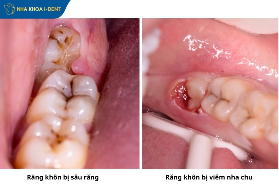 nhổ răng khôn bị sâu