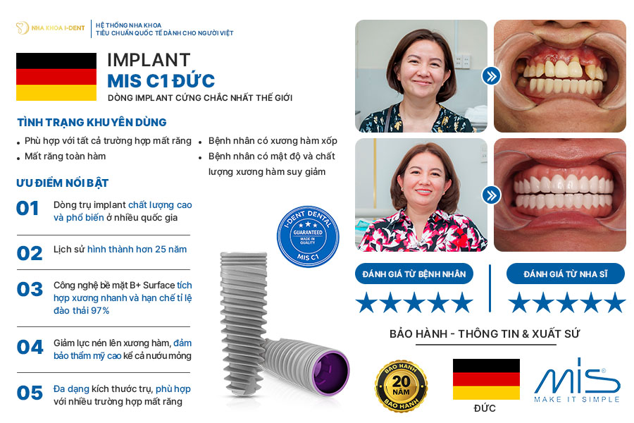 so sánh trụ implant nào tốt