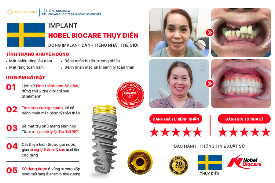sự khác nhau giữa các loại implant