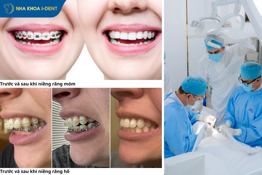 tại sao phải niềng răng