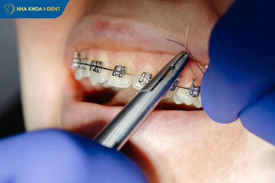 nhổ răng số 8 tạo khoảng di chuyển răng