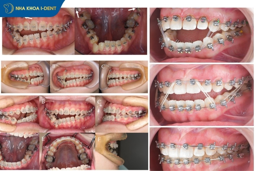 thời gian chỉnh khớp cắn