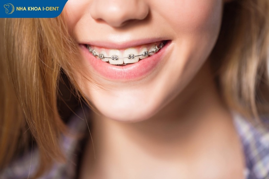 thời gian niềng răng người lớn