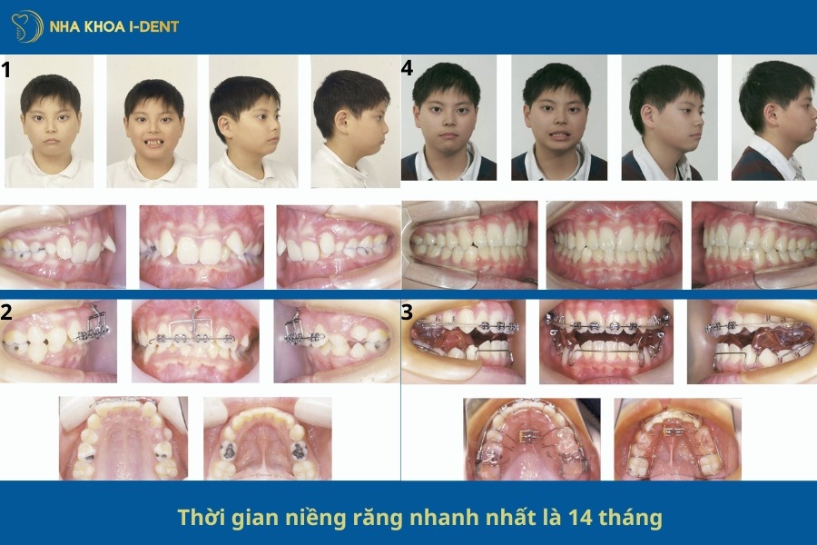 thời gian niềng răng nhanh nhất