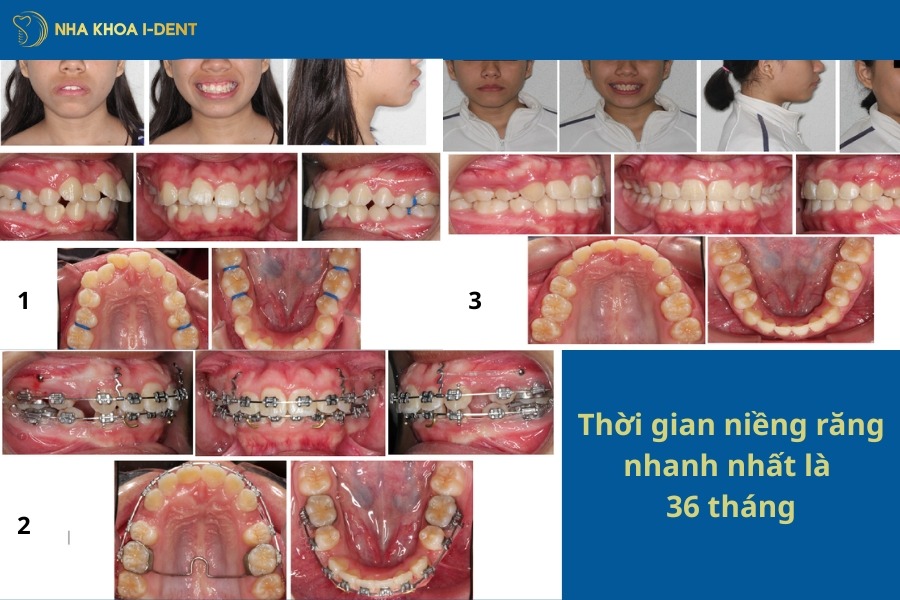 thời gian niềng răng lâu nhất