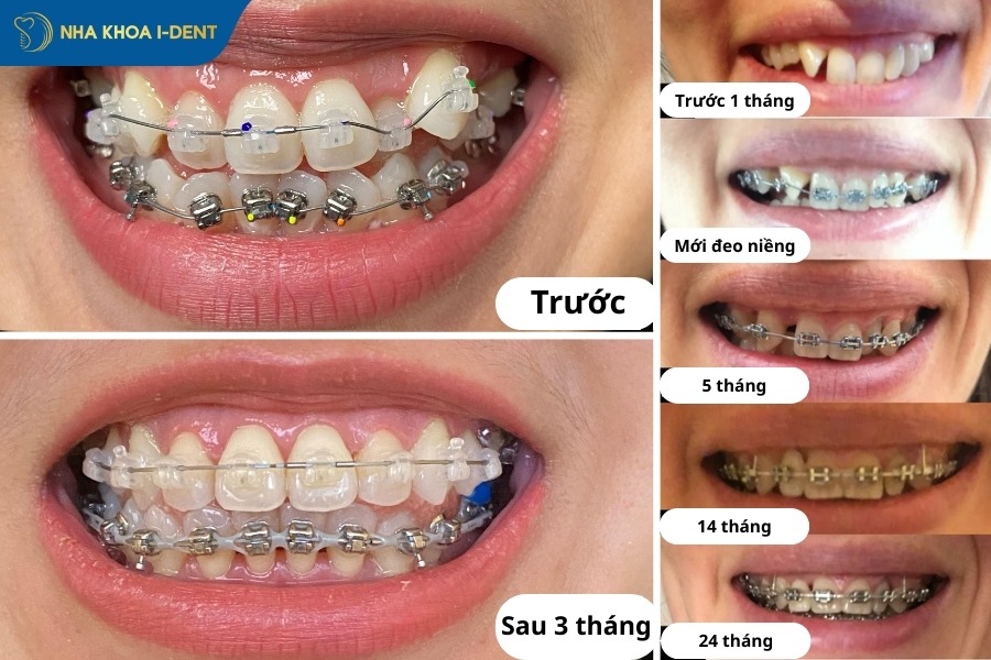 niềng răng bao lâu có kết quả