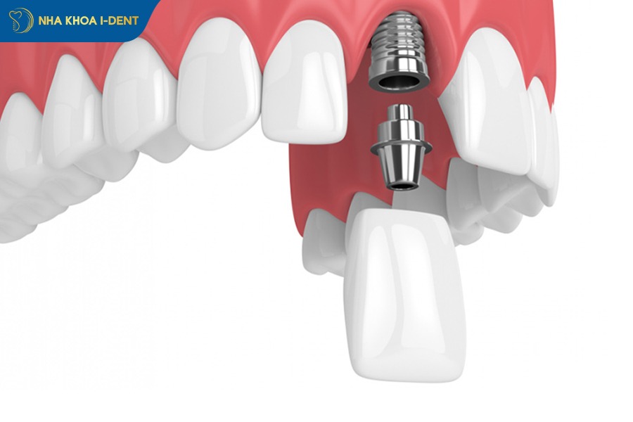 Trồng răng implant là phương pháp hiệu quả để phục hồi răng cửa bị gãy 