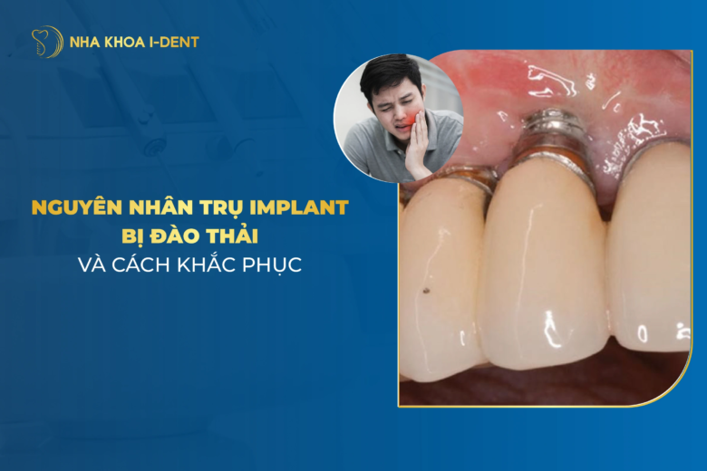 Trụ implant bị đào thải do đâu? Cách khắc phục