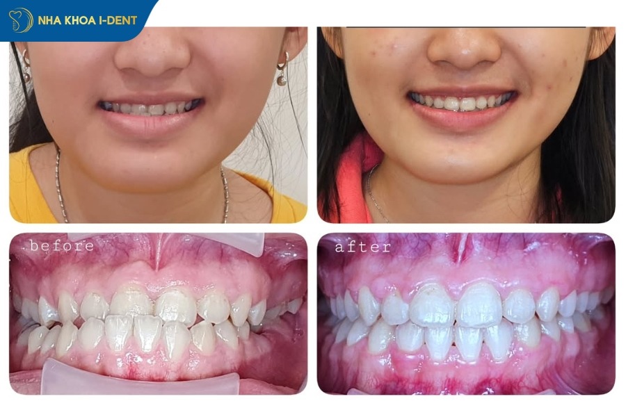 khuôn mặt trước và sau khi niềng răng