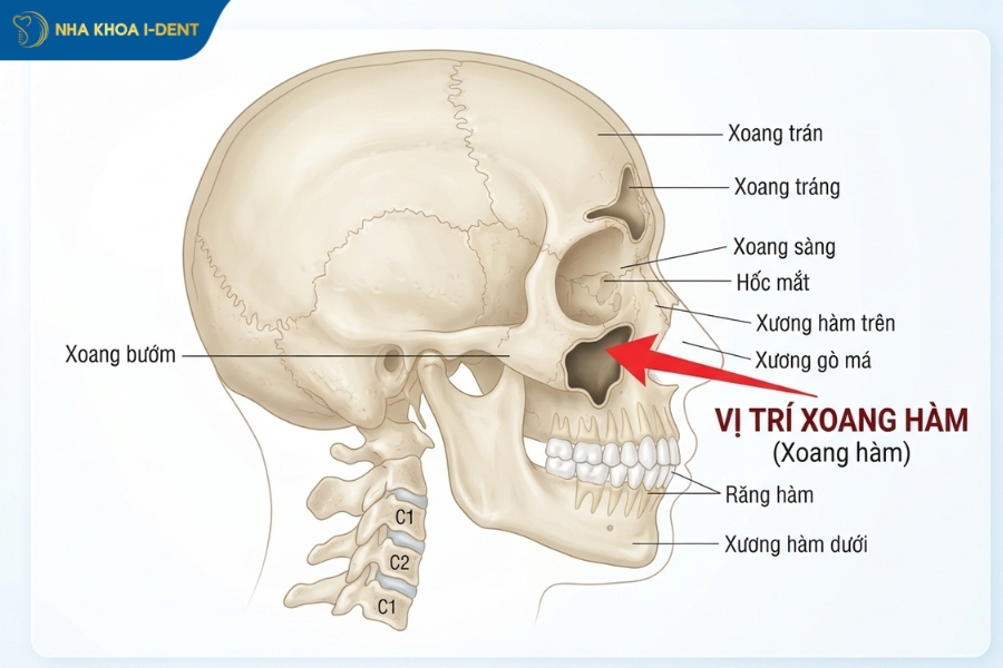 nâng xoang hàm - Nha khoa I-Dent