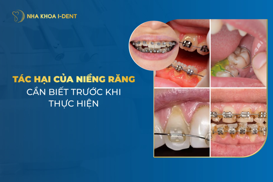 Top 10 tác hại của niềng răng tại nha khoa kém chất lượng bạn cần biết