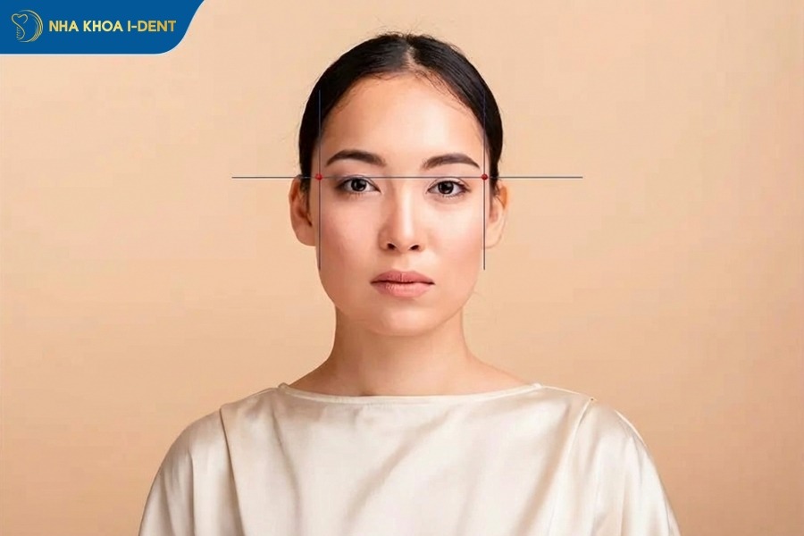 niềng răng hóp thái dương