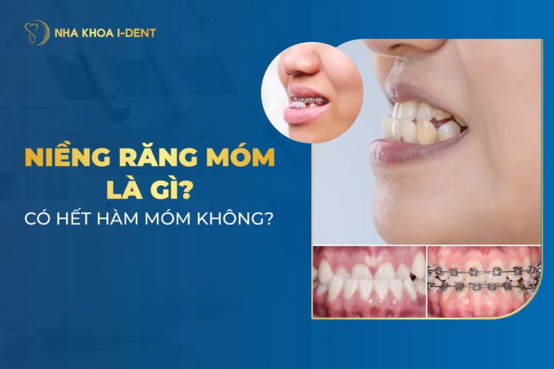 bị móm có nên niềng răng có hết móm
