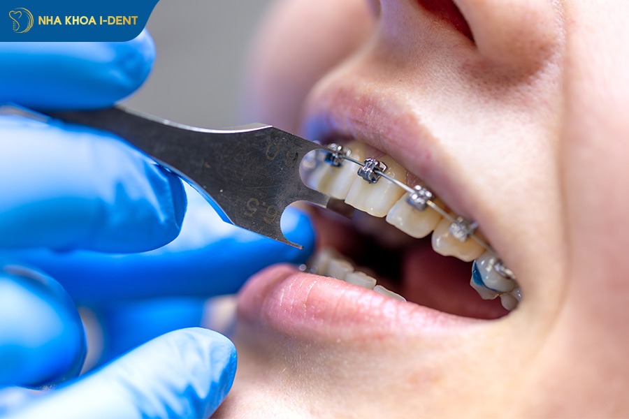 ê khi niềng răng