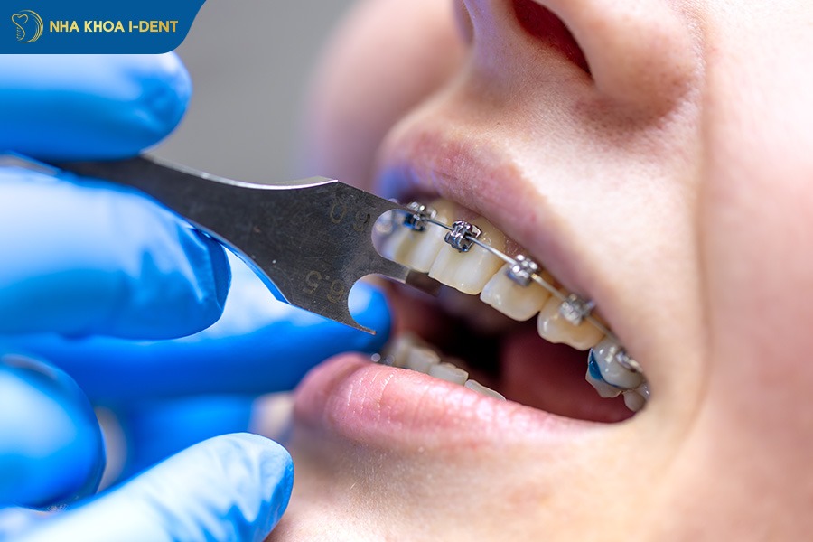 Gắn khí cụ niềng răng