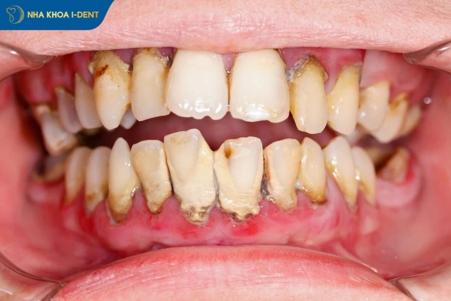 giá cạo vôi răng