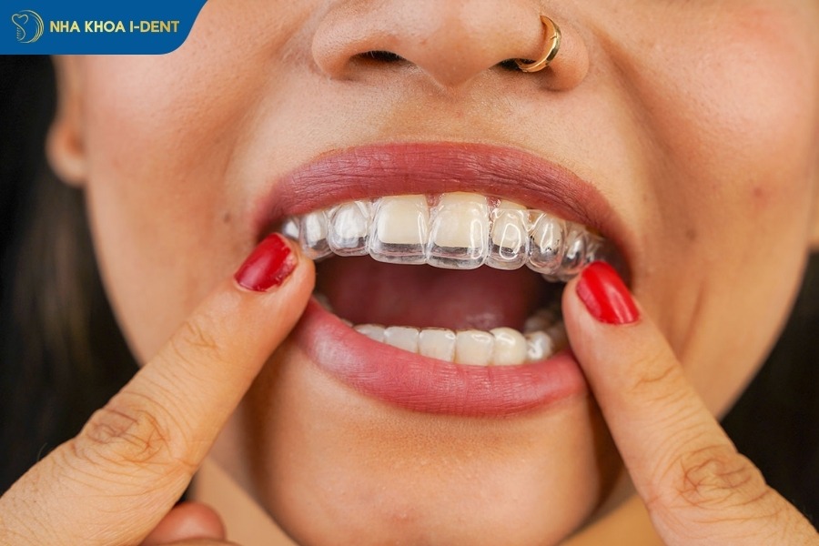 Giá niềng răng trong suốt Invisalign