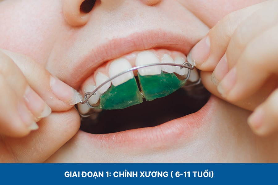 Giai đoạn 1: Chỉnh xương