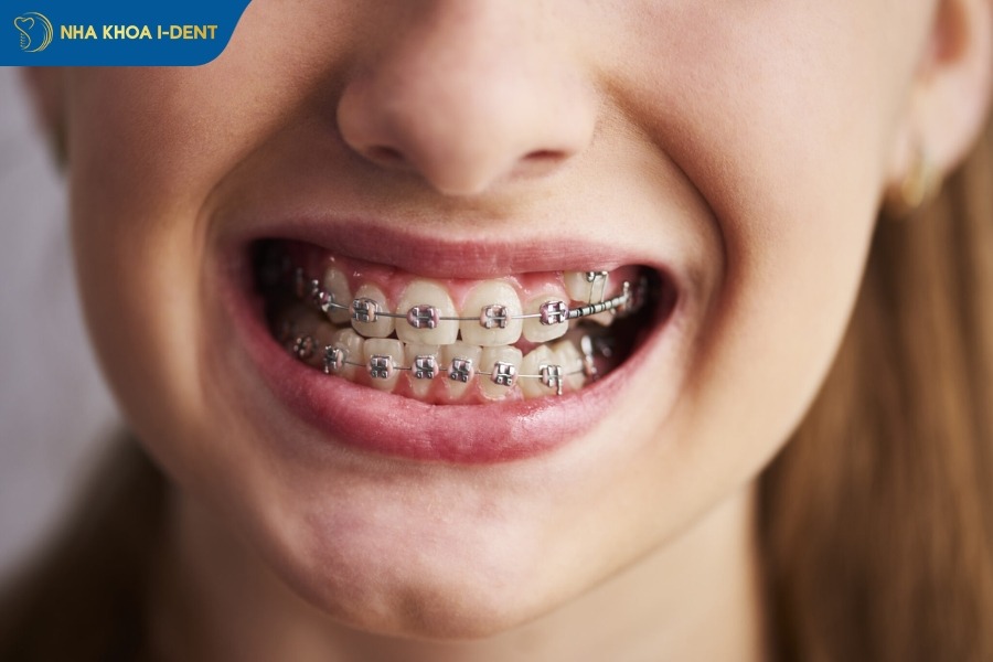niềng răng có mấy giai đoạn
